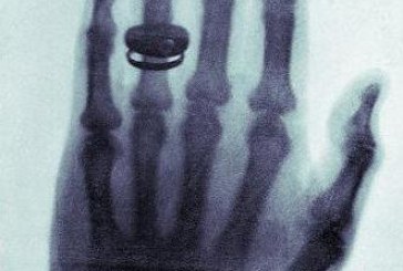 1895: Wilhelm Röntgen Discovers X-rays